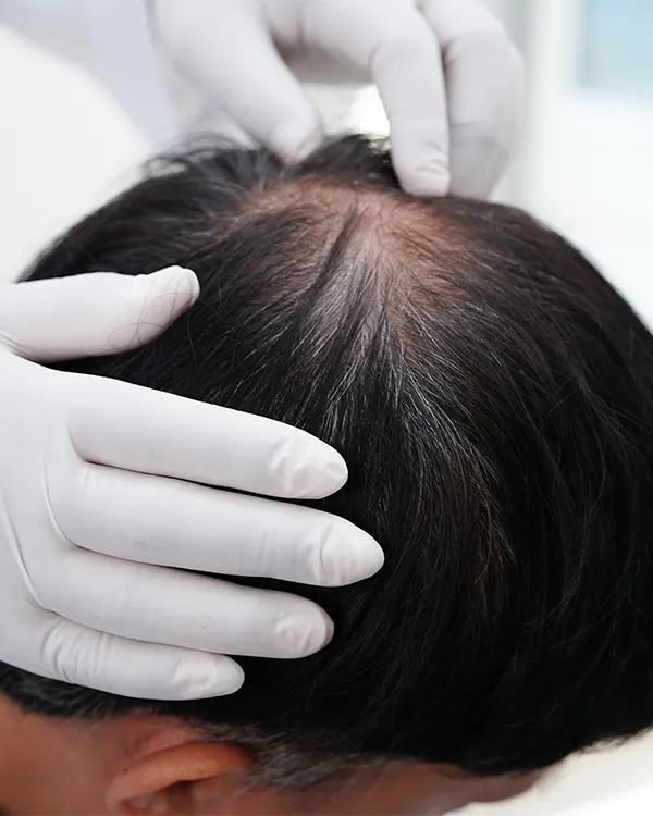 Img-Caida de pelo