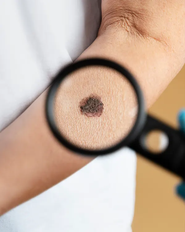 Img-Cáncer de piel