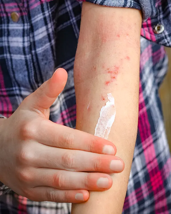 Img-Dermatitits