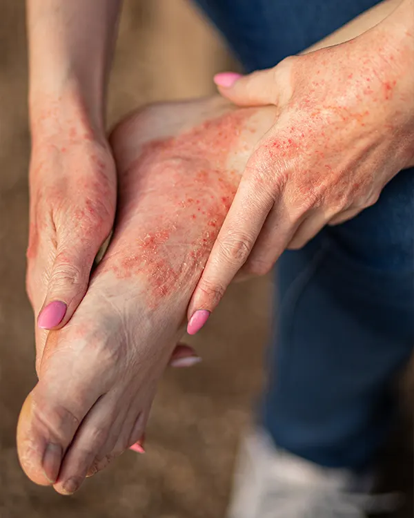 Img-Psoriasis