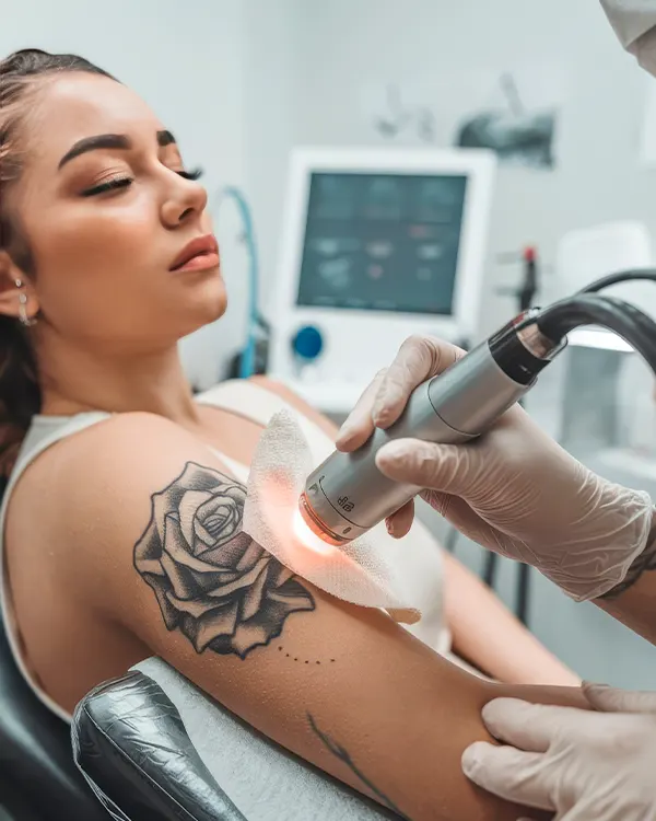 img-quitar-tatuajes-en-guatemala-1